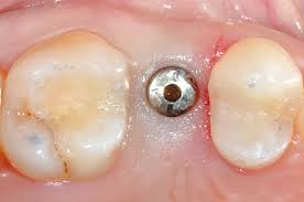 Collacone Botiss Dental Botiss Biomaterials Gmbh