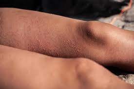 Sonnenallergie Ursachen Behandlung Apotheke Sterzing