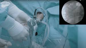 Ureteroscopy (urs) your doctor may recommend urs surgery if you have a large stone in your kidney or ureter. Operasi Urs Ureteroskopi Untuk Batu Ginjal Dan Saluran Kemih