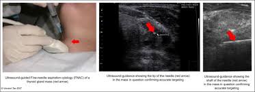 Coretan coklat atau hitam atau titik di bawah kuku boleh menunjukkan kanser kulit. Vincent Ent Thyroid Head And Neck Surgery Specialist Clinic Klang Shah Alam Subang Pj Kl And More