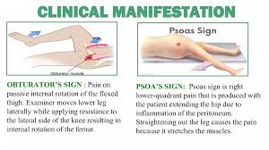 Image result for Obturator Sign