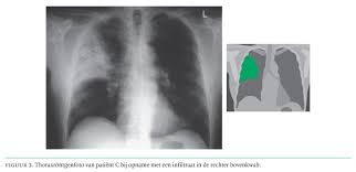Drugs used to treat legionella pneumonia. Drie Patienten Met Legionella Pneumonie In Verband Gebracht Met Een Sauna Een Koeltoren En Een Caravan In Nederland Nederlands Tijdschrift Voor Geneeskunde
