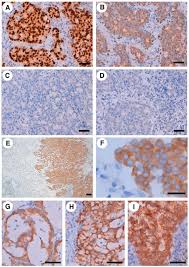 Immunohistochemical Analysis Of Non Small Cell Lung Carcinoma Download Scientific Diagram