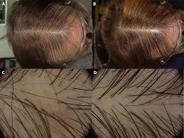 Using cream for vaginal prolapse (to restore thickness to vaginal wall) but noticed excess hair loss the day after i use it. Efficacy Of Topical Finasteride 0 5 Vs 17a Estradiol 0 05 In The Treatment Of Postmenopausal Female Pattern Hair Loss A Retrospective Single Blind Study Of 119 Patients Dermatology Practical Conceptual