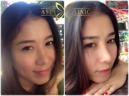 In fact, nose job before and after photos of asian women are some of the most dramatic and impressive. The Best Nose Augmentation Rhinoplasty In Thailand Dr Tanongsak