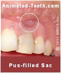 The entire procedure should feel similar to having a cavity filled. How Do You Know If You Need Root Canal Treatment Signs Symptoms Pain Swelling
