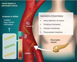 Pancreatic cancer is the most aggressive, least treatable form of the disease, and in a large majority of cases it reduces the victim's life expectancy to a matter of months. Liquid Biopsy For Early Detection Of Pancreatic Cancer Springerlink