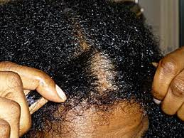 What is a natural dandruff treatment for black hair? How To Treat Dry Scalp In African American Hair Dryscalpgone