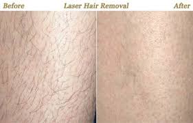 How much is laser hair removal for brazilian. Laser Hair Removal Minneapolis Mn