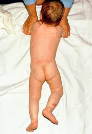 Image result for scabies human children