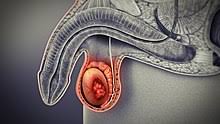 If testicular cancer progresses further, cancer cells can spread throughout the body via lymphatic and blood vessels and form new tumours somewhere. Testicular Cancer Wikipedia