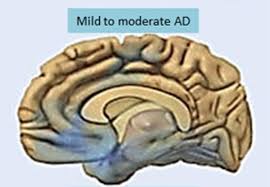 Though the alzheimer's camel test gained online popularity, it's ineffective at diagnosing neurological dementia. New Test Can Detect Who Is Most At Risk For Alzheimer S Disease Neuroscience News