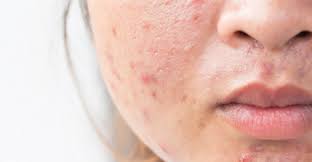 It goes without saying that it is safe to also use it all. How To Get Rid Of Acne Scars Fast And Naturally 19 Strategies