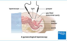 Gynaecological Laparoscopy Health Information Bupa Uk