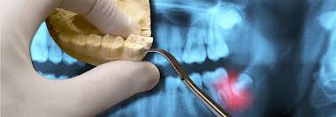 Medical insurance also has some caveats for covering wisdom teeth extraction. Wisdom Teeth Removal Penn Dental Medicine