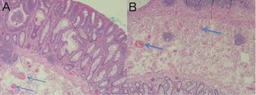 Transverse colon polyp biopsy with H&E stain (magnification ×50)...