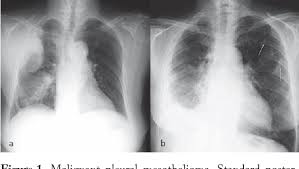 In one retrospective study, researchers reported 88% of malignant pleural mesothelioma patients showed pleural thickening on ct scan images. Pdf Diagnostic Imaging And Workup Of Malignant Pleural Mesothelioma Semantic Scholar