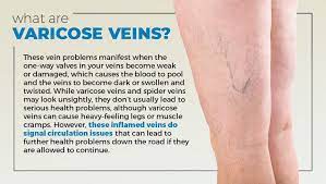 How To Treat Varicose Veins In Your 20s Loungedoctor Com Lounge Doctor