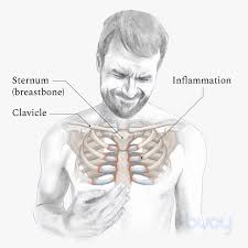 Is your heart under your third rib. Acute Costochondritis Symptoms Treatment Of Chest Wall Pain