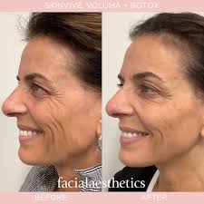 Smooth, lift, and hydrate 🤩 One month after her appointment with our  Greenwood Village aesthetic injector Brenna, this patient is absolutely  glowing! Brenna treated her patient with Botox in her crows feet