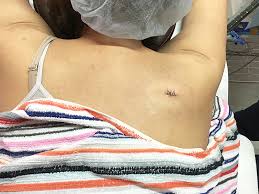 脂肪腫 形成外科 美容外科 美容皮膚科のjr本千葉駅徒歩2分のhsクリニック