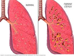 Savesave fibrose quistica for later. Laboratorio Richet