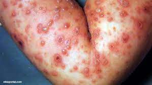 It is also considered possible to transfer chickenpox to the fetus from the mother during pregnancy. Chicken Pox Cacar Air Pusat Rawatan Impian