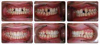 Dental Bridge Tooth Bridges Available 7 Days A Week In Kingston London