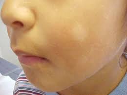 The cause is unknown but may be linked to atopic dermatitis (eczema). Homoeopathic Remedies For Pityriasis Alba White Skin Spots White Patches Treatment Itching Skin