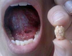 Image result for Sialolithiasis