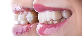 We did not find results for: A Clear Look At The Invisalign Pros And Cons National Dental