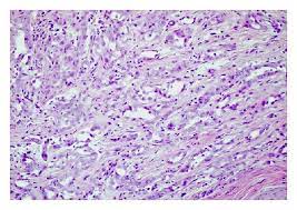 Mph affects more men than women. Abdominal Mass Biopsy Showing Mesothelioma H E Low Power Download Scientific Diagram