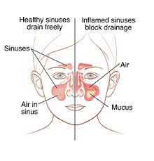 Please call your location in advance before your visit. When Your Child Has Sinusitis Saint Luke S Health System