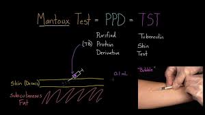 The different tests for tb include the skin test, the sputum test and the igras. Mantoux Test Aka Ppd Or Tst Youtube