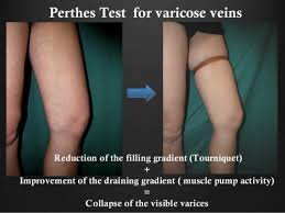 Image result for Perthes Test