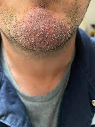 This is easy to apply. Redness And Dry Skin With Inflamed Hair Follicles Any Help Appreciated Dermatologyquestions