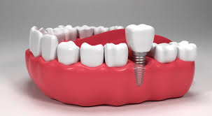 A Guide to The Dental Implant Procedure Step by Step