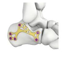 Itval Calcaneal MIS Locking Plate,Medical Device ...