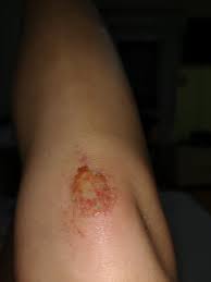 Schurfwunde Knie Eiter