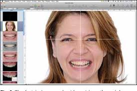 Figure 2 from Digital Smile Design: A Tool for Treatment Planning and  Communication in Esthetic Dentistry