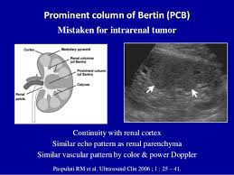 Prominent Column Of Bertin Often Mistaken For Tumor Uzi