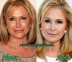 Kathy Hilton Plastic Surgery Before And After Plastic Surgery Adele Weight Kathy Hilton