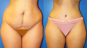 The table below provides a general outline of potential cost factors. Tummy Tuck Abdominoplasty Nyc Top Ranked Zuckerman Plastic Surgery