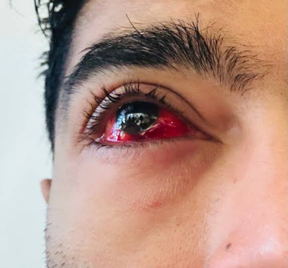 Abhishek Banerjee on X: "I want to extend my heartfelt thanks to everyone for their kind wishes following my recent eye surgery. Since the road accident in 2016, I have faced ongoing