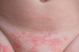 Bei der windeldermatitis handelt es sich sogar um die häufigste kindererkrankung bei säuglingen und kleinkindern. Windeldermatitis Rundumgesund De