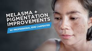 Melasma + Pigmentation Improvements