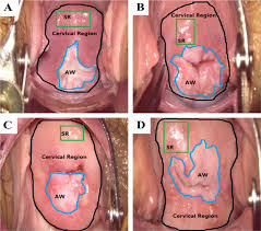 Image result for Colposcopy Findings