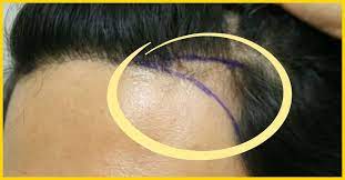 8 Simple Ways To Treat Hair Loss At The Temples Temple Hair Loss Vitamins For Hair Loss Hair Loss Remedies