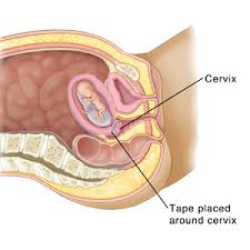 Abdominal wall anatomy that is clinically pertinent to the surgeon, focusing primarily on the structures of the anterior abdominal wall, will be reviewed. Pregnancy And Childbirth Abdominal Cerclage Saint Luke S Health System