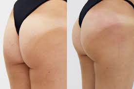 It is also known by the term 'ptosis' and tends to be a cosmetic change rather than a medical condition. This Non Surgical Butt Lift Can Transform The Shape Of Your Bum In Just One Hour Mirror Online